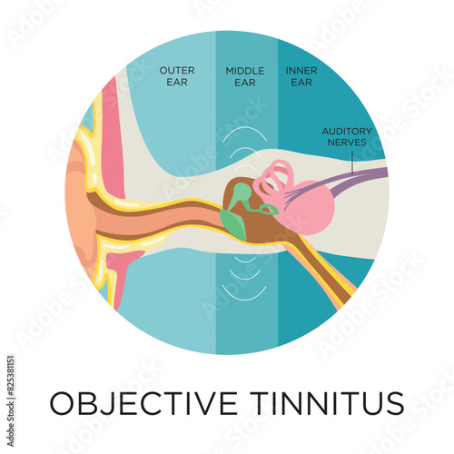 Objective tinnitus flat style vector illustration in circle layout with type, medical infographic