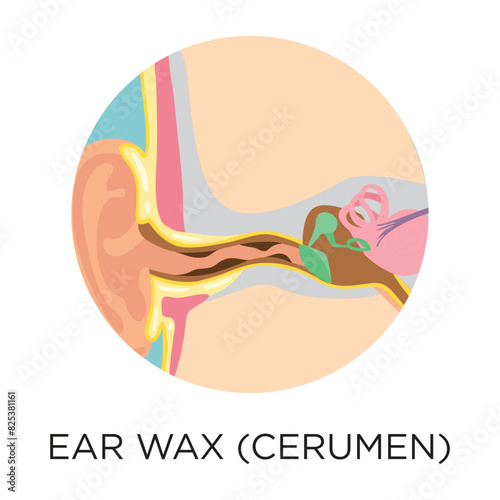 Ear wax (cerumen) flat style vector illustration in circle layout with type, medical infographic