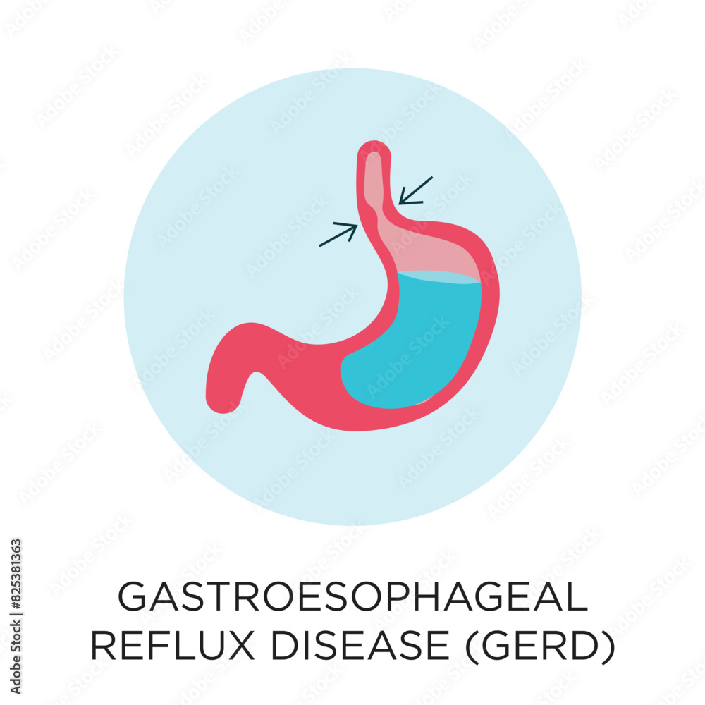 Gastroesophageal Reflux Disease (GERD) with stomach vector icon