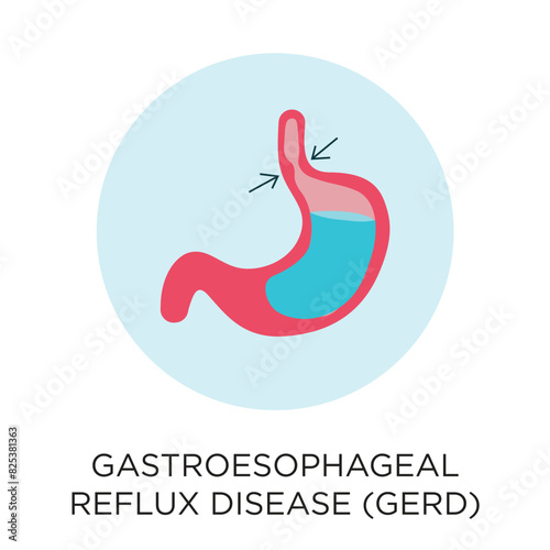 Gastroesophageal Reflux Disease (GERD) with stomach vector icon