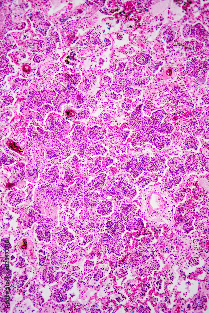 Micrograph of lobar pneumonia haemorrhagic edema period Micrograph of lobar pneumonia haemorrhagic edema period