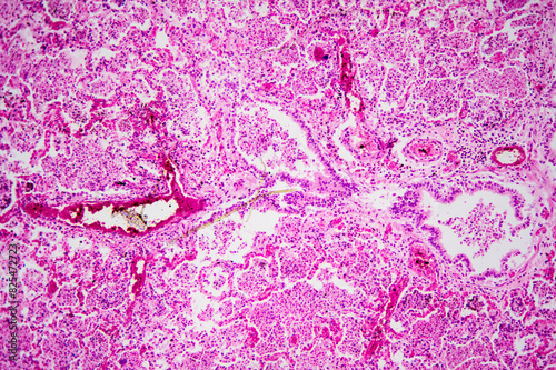 Micrograph of lobar pneumonia haemorrhagic edema period photo