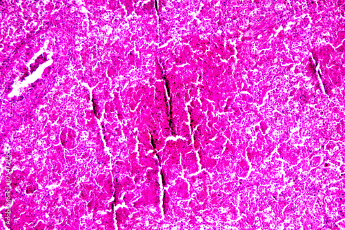 Micrograph of lobar pneumonia red hepatization stage photo