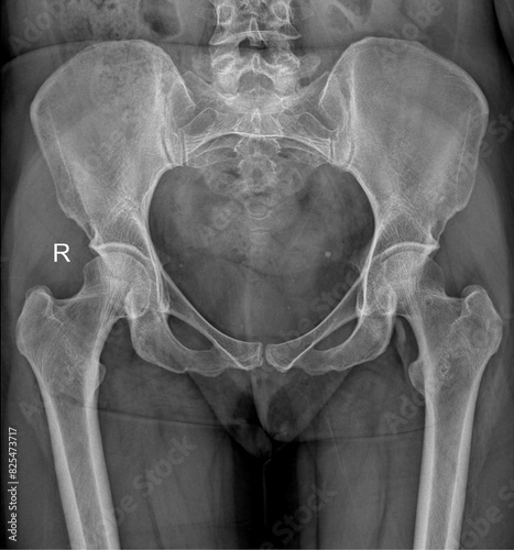 Foto Female Anteroposterior Radiograph of the Pelvic Girdle