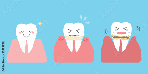 歯周病の進行 歯のシンプルイラスト
