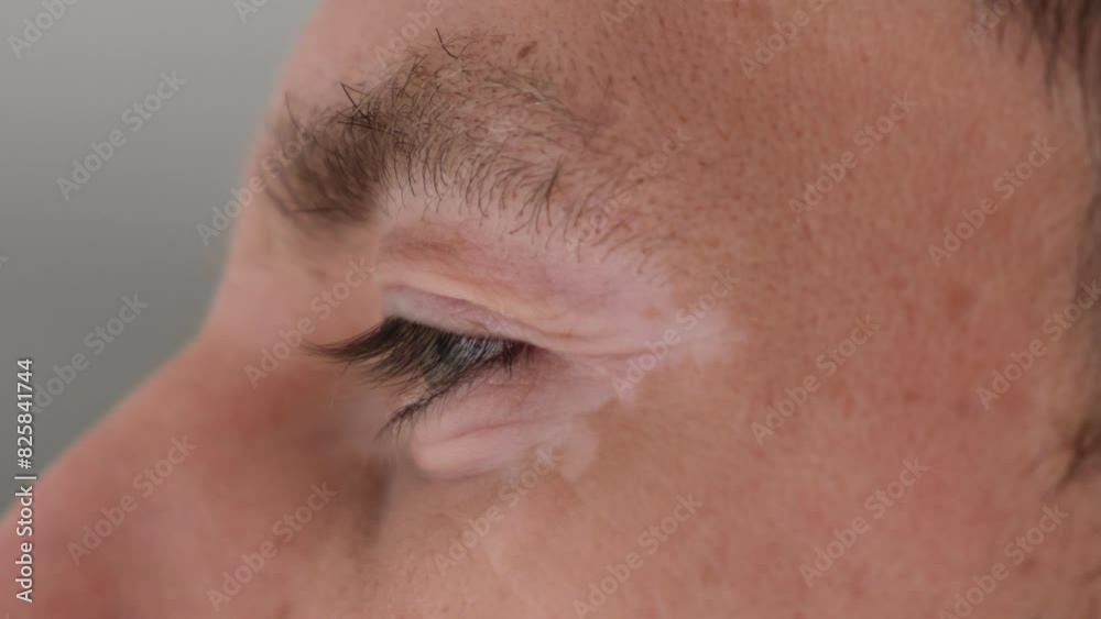 Human skin on the face, eyes with vitiligo close-up Human skin on the face, eyes with vitiligo close-up