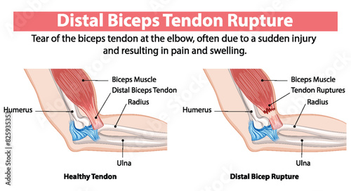 Comparison of healthy and ruptured biceps tendon
