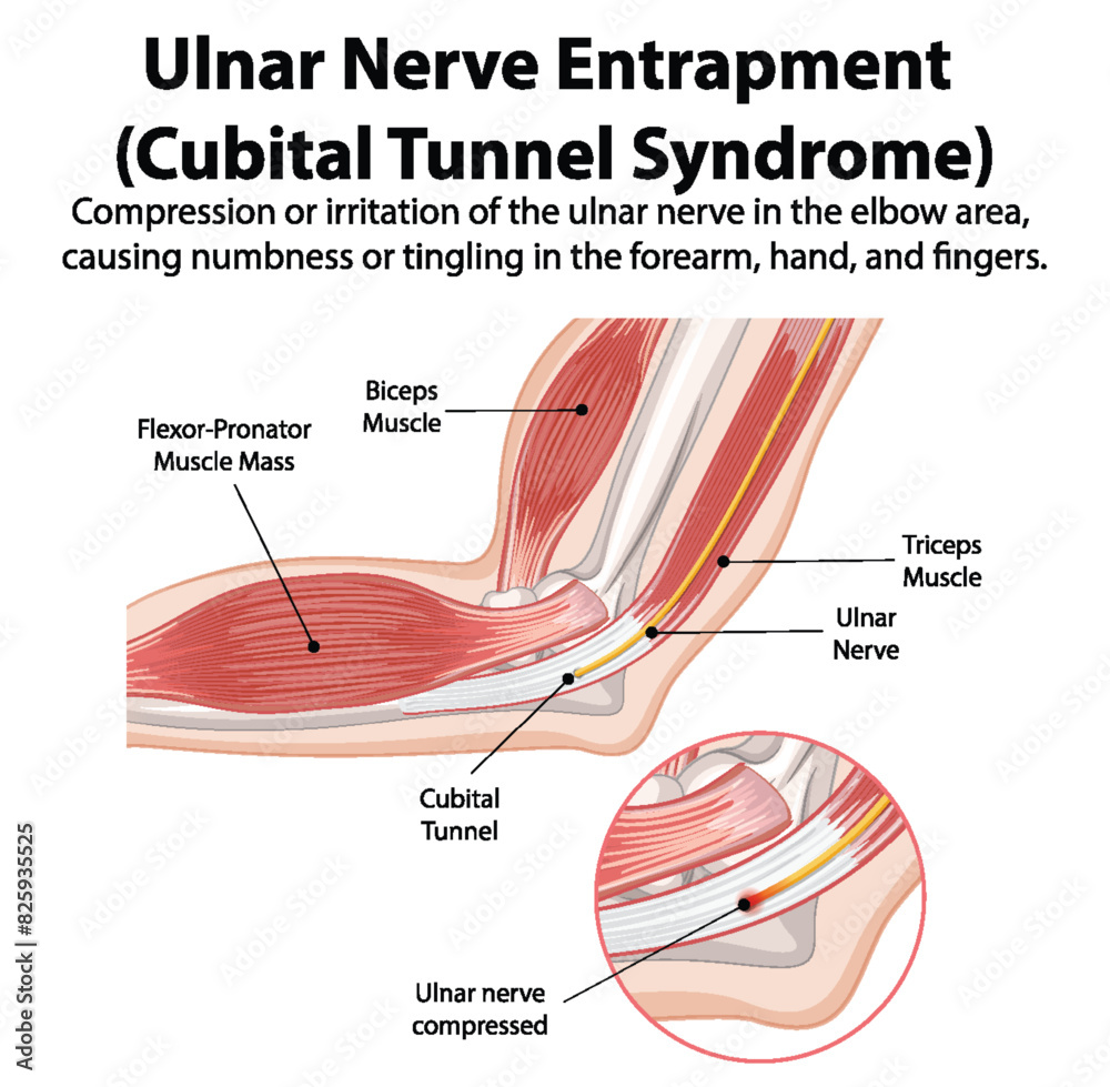Detailed Diagram Of Cubital Tunnel Syndrome Stock Vector Adobe Stock Detailed Diagram Of Cubital Tunnel Syndrome Stock Vector Adobe Stock