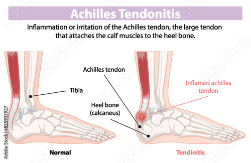 Comparison of normal and inflamed Achilles tendon