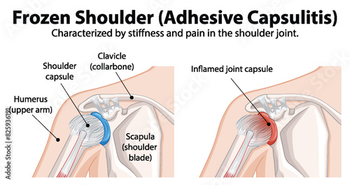 Diagram showing frozen shoulder anatomy and inflammation