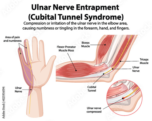 Detailed diagram of cubital tunnel syndrome
