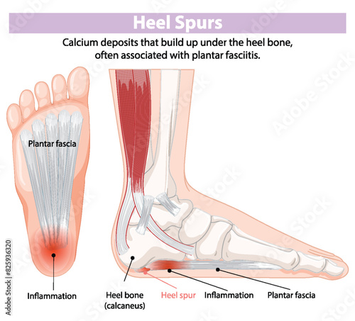 Illustration of heel spurs and inflammation