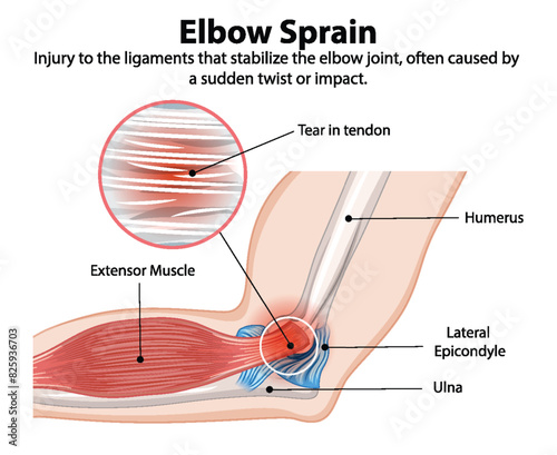 Detailed diagram of elbow sprain injury