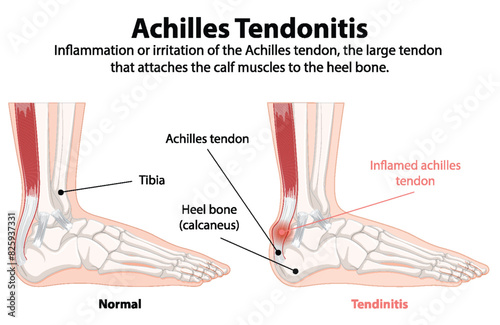 Comparison of normal and inflamed Achilles tendon