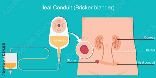 Ileal conduit or Bricker Bladder.