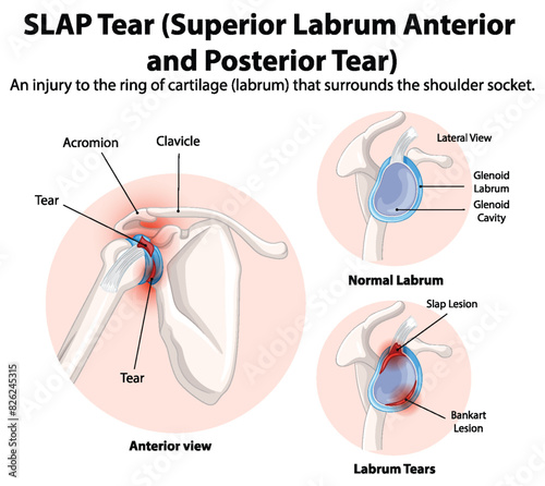 Detailed diagram of SLAP tear in shoulder joint