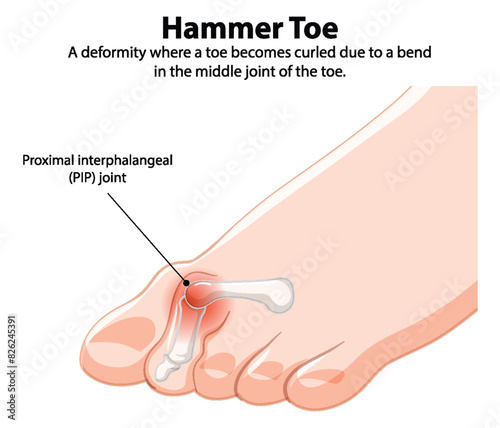 Diagram showing hammer toe deformity and PIP joint