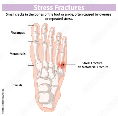 Diagram showing stress fractures in foot bones