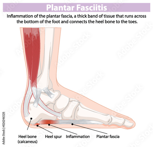 Detailed diagram of foot inflammation