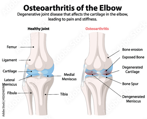 Comparison of healthy and osteoarthritic elbow joints