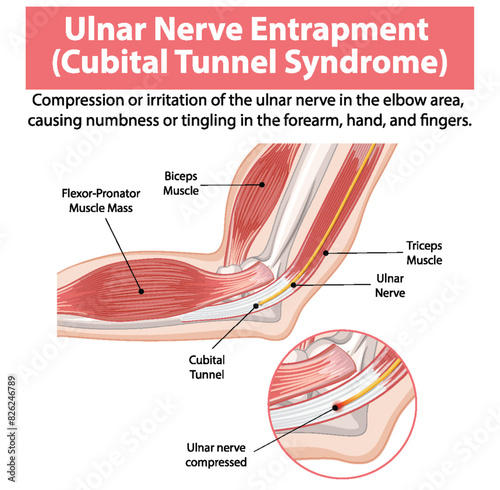 Detailed anatomy of cubital tunnel syndrome