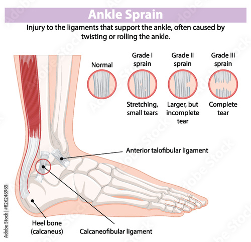 Detailed diagram of ankle sprain types