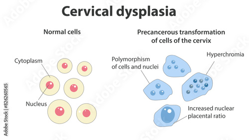 Cervical dysplasia. Normal squamous epithelial cells and atypical precancerous transformation of cervical cells. Cervical cancer, intraepithelial neoplasia. Cytology of CIN. Healthcare.