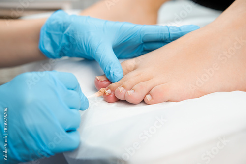 Close up podologist treats the nail with an antifungal agent.  photo