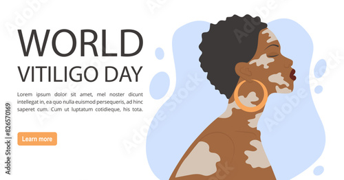 Afro american woman illustration with vitiligo banner. World Vitiligo Day