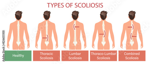 Types of scoliosis, spinal disease. Infographics banner with human scoliosis spine. Healthcare and medicine. Illustration, poster