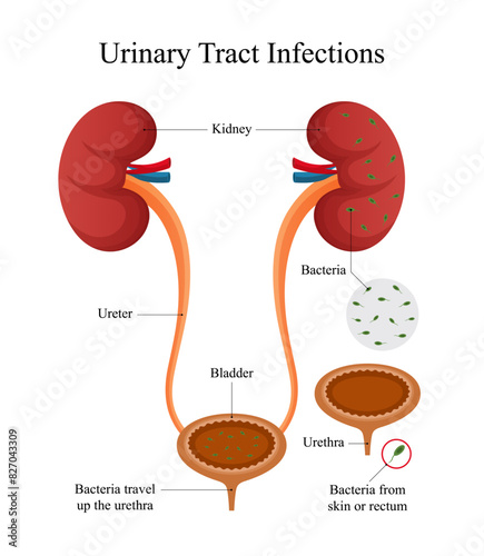 Urinary Tract Infection (UTI) Diagram Design for Medical