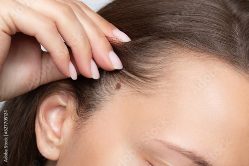 A large mole or birthmark on a woman's scalp. The girl shows with her fingers a dark brown spot on the skin. Nevus on the head close-up. Medicine and health, dermatology. Mole removal concept