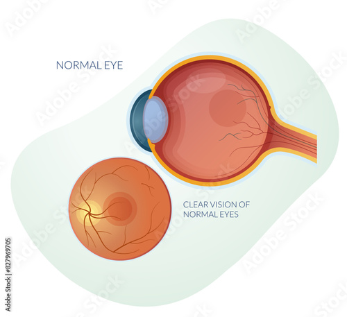 Normal Eye without any Dry or Wet Macular Degeneration - Stock Illustration
