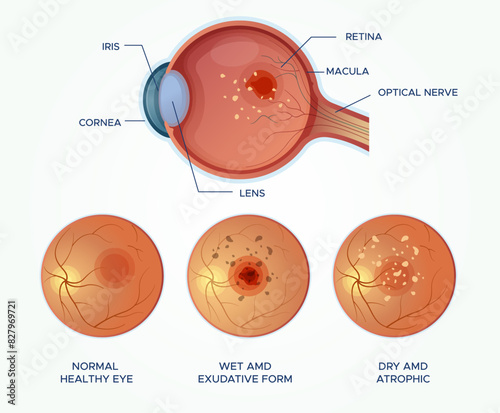Understanding Macular Degeneration Healthy Eyes vs Wet and DRY AMD - Stock Illustration