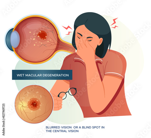 Wet Macular Degeneration - Blurry vision - Stock Illustration