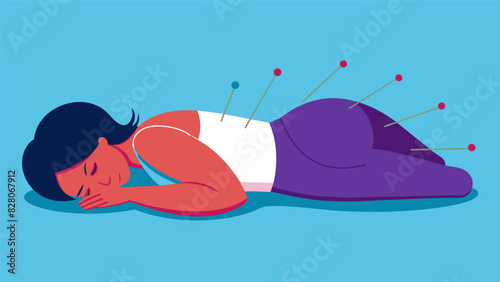 A person lying on their stomach with acupuncture needles p along their back to help relieve tension and improve overall health.. Vector illustration