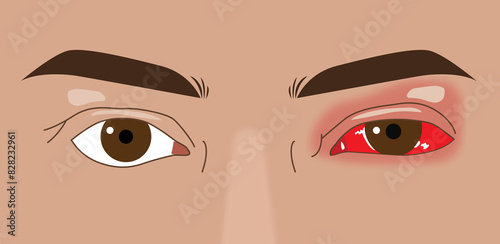 Tableau sur toile Blepharitis or conjunctivitis red eye, close-up illustration