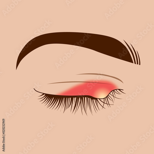 Patients ophthalmic blepharitis infection on upper eyelid, close-up illustration
