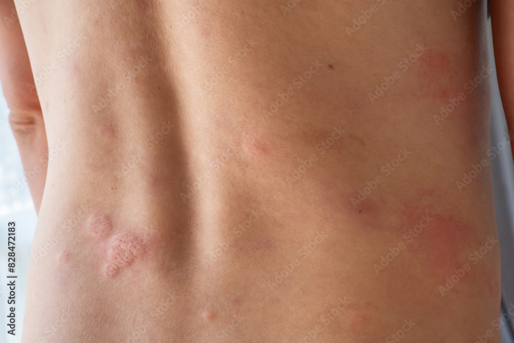 Young asian man itching and scratching on his back from allergic itchy dry skin eczema dermatitis insect bites Young asian man itching and scratching on his back from allergic itchy dry skin eczema dermatitis insect bites