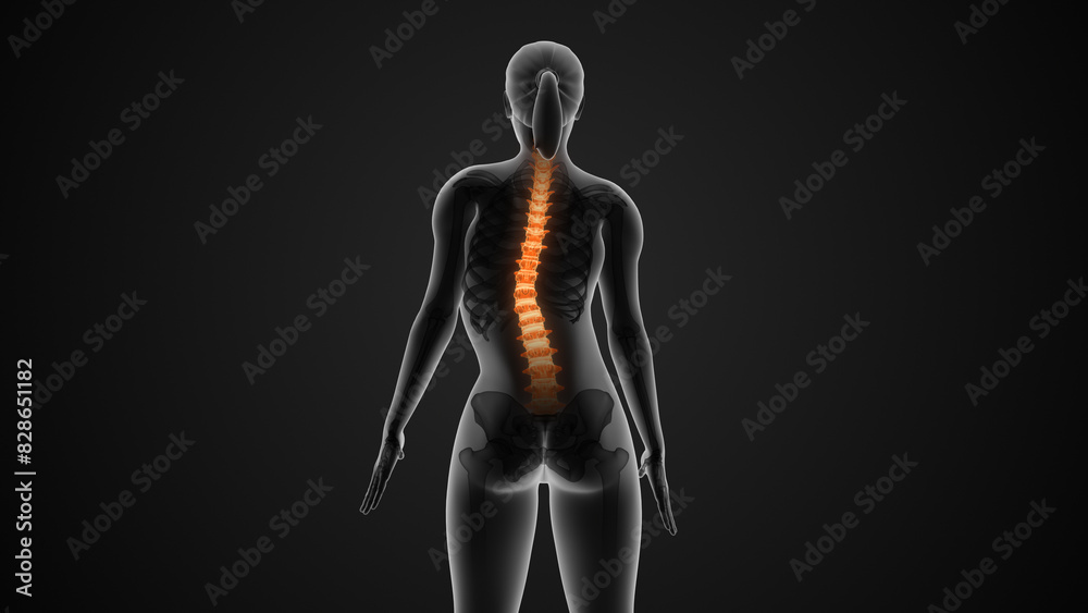 The medical condition of scoliosis of the spine