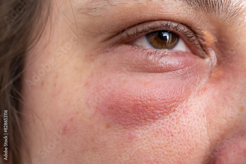 Swallen eye, external Chalazion or Hordeolum (Stye), on a Caucasian woman's eyelid photo