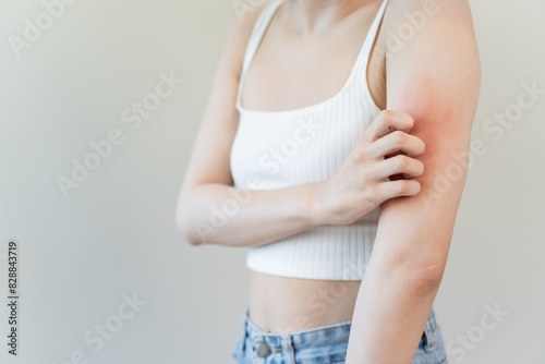 Sensitive skin allergic concept, Woman itching on her arm have a red rash from allergy symptom and from scratching.
