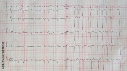 ECG showing Atrial Fibrillation 