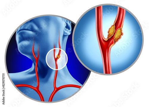 Foto Carotid Artery Disease as arteries bringing blood flow to the brain is interrupt