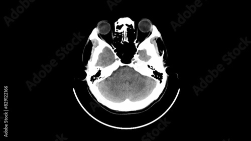 Принти на полотні normal head ct scan brain window