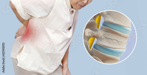 Back pain and spinal anatomy 3d illustration of elderly women_spinal compression fracture