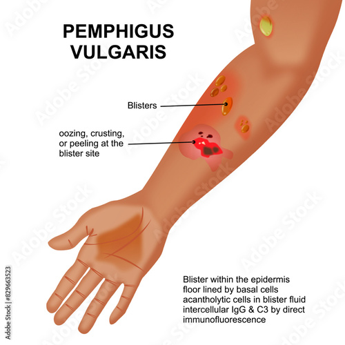 Pemphigus vulgaris illustration blisters on hand