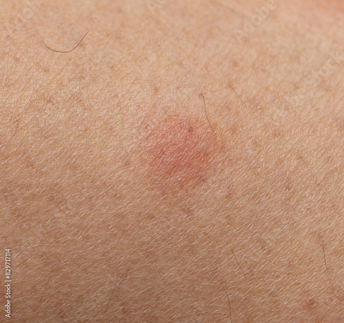 red spots from a mosquito bite.
