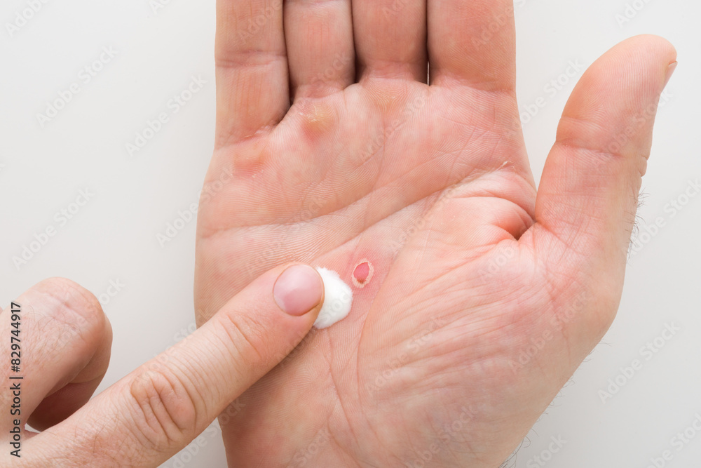 Young adult man finger applying white medical ointment on red callus on palm after work on light gray table background. First aid. Self help. Closeup. Point of view shot. Top down view. Young adult man finger applying white medical ointment on red callus on palm after work on light gray table background. First aid. Self help. Closeup. Point of view shot. Top down view.