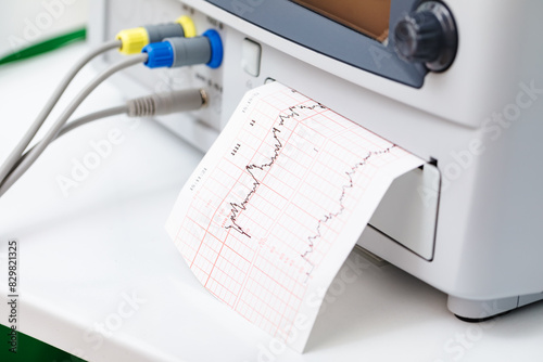 Cardiotocography CTG Fetal Heartbeat Monitoring Printout